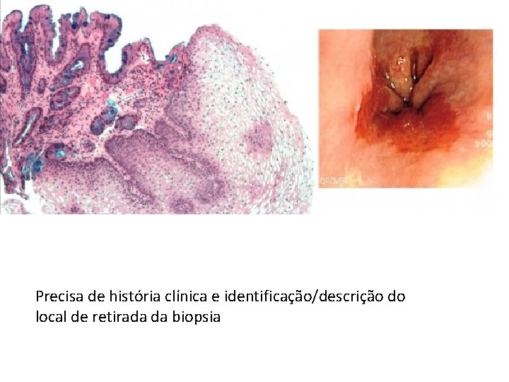 Precisa de história clínica e identificação/descrição do local de retirada da biopsia Precisa de história clínica e identificação/descrição do local de retirada da biopsia