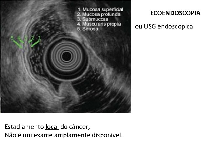 ECOENDOSCOPIA ou USG endoscópica Estadiamento local do câncer; Não é um exame amplamente disponível. ECOENDOSCOPIA ou USG endoscópica Estadiamento local do câncer; Não é um exame amplamente disponível.
