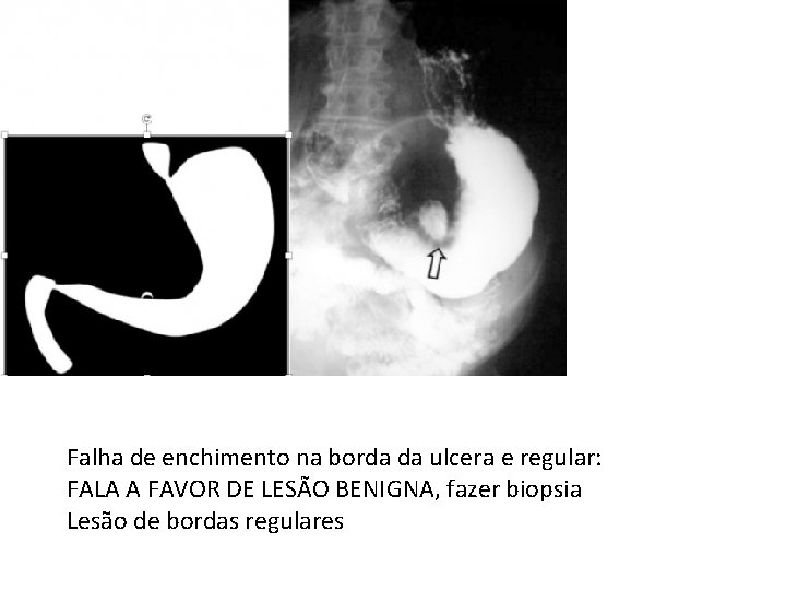Falha de enchimento na borda da ulcera e regular: FALA A FAVOR DE LESÃO Falha de enchimento na borda da ulcera e regular: FALA A FAVOR DE LESÃO