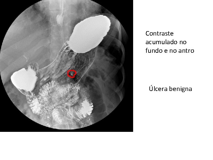 Contraste acumulado no fundo e no antro Úlcera benigna Contraste acumulado no fundo e no antro Úlcera benigna