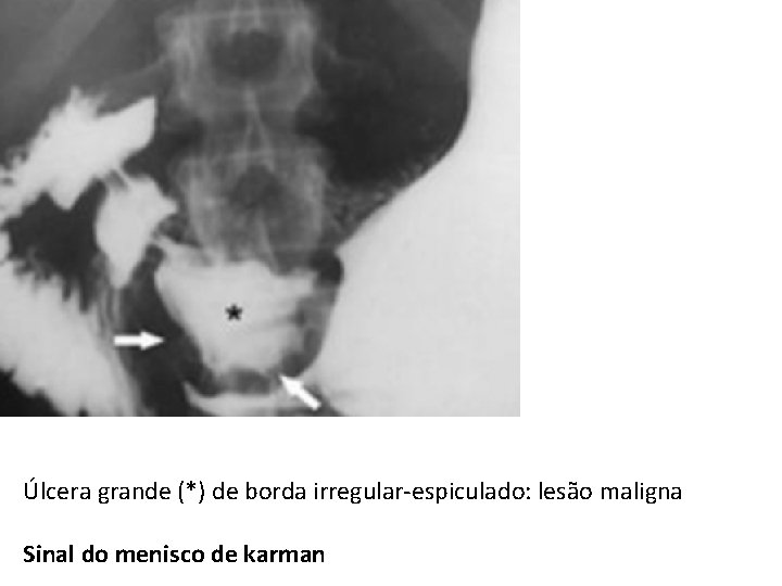 Úlcera grande (*) de borda irregular-espiculado: lesão maligna Sinal do menisco de karman Úlcera grande (*) de borda irregular-espiculado: lesão maligna Sinal do menisco de karman