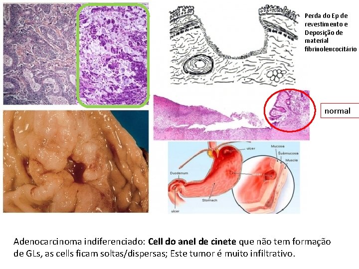 Perda do Ep de revestimento e Deposição de material fibrinoleucocitário normal Adenocarcinoma indiferenciado: Cell Perda do Ep de revestimento e Deposição de material fibrinoleucocitário normal Adenocarcinoma indiferenciado: Cell