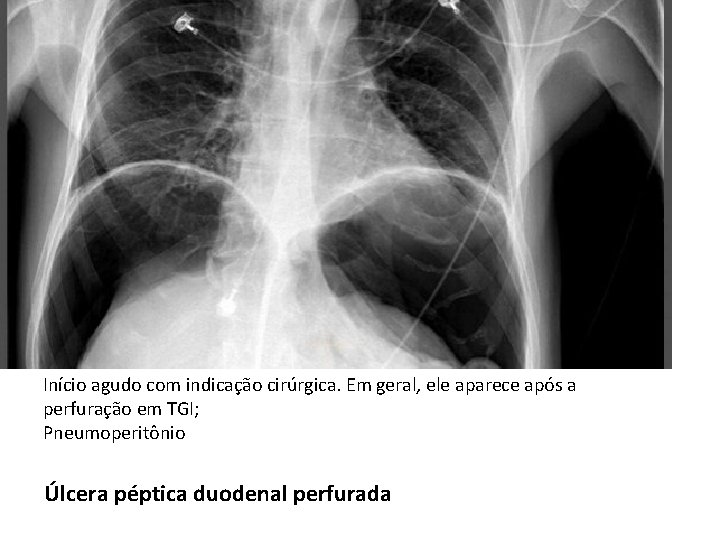 Início agudo com indicação cirúrgica. Em geral, ele aparece após a perfuração em TGI; Início agudo com indicação cirúrgica. Em geral, ele aparece após a perfuração em TGI;