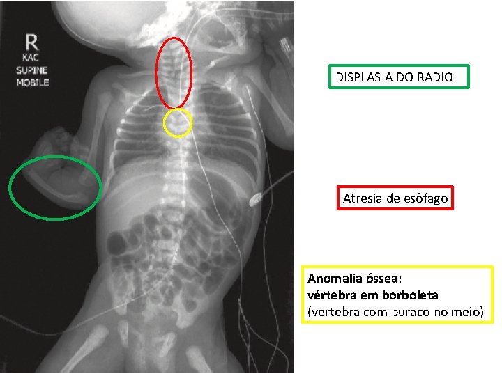 DISPLASIA DO RADIO Atresia de esôfago Anomalia óssea: vértebra em borboleta (vertebra com buraco DISPLASIA DO RADIO Atresia de esôfago Anomalia óssea: vértebra em borboleta (vertebra com buraco