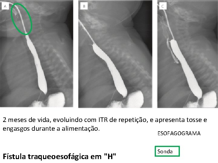 2 meses de vida, evoluindo com ITR de repetição, e apresenta tosse e engasgos 2 meses de vida, evoluindo com ITR de repetição, e apresenta tosse e engasgos