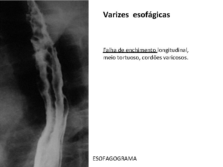Varizes esofágicas Falha de enchimento longitudinal, meio tortuoso, cordões varicosos. ESOFAGOGRAMA Varizes esofágicas Falha de enchimento longitudinal, meio tortuoso, cordões varicosos. ESOFAGOGRAMA