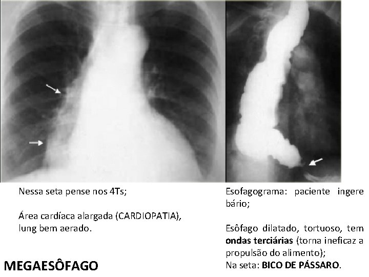 Nessa seta pense nos 4 Ts; Área cardíaca alargada (CARDIOPATIA), lung bem aerado. MEGAESÔFAGO Nessa seta pense nos 4 Ts; Área cardíaca alargada (CARDIOPATIA), lung bem aerado. MEGAESÔFAGO