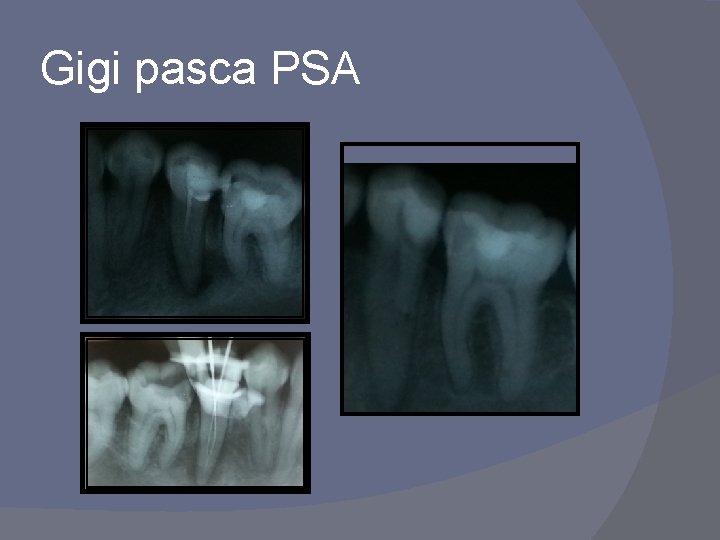 Gigi pasca PSA 