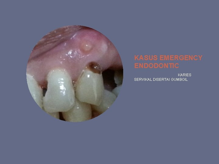 KASUS EMERGENCY ENDODONTIC KARIES SERVIKAL DISERTAI GUMBOIL 