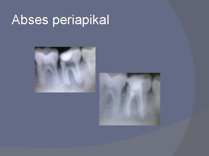 Abses periapikal 