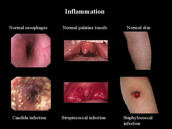 Inflammation Normal oesophagus Normal palatine tonsils Normal skin Candida infection Streptococcal infection Staphylococcal infection