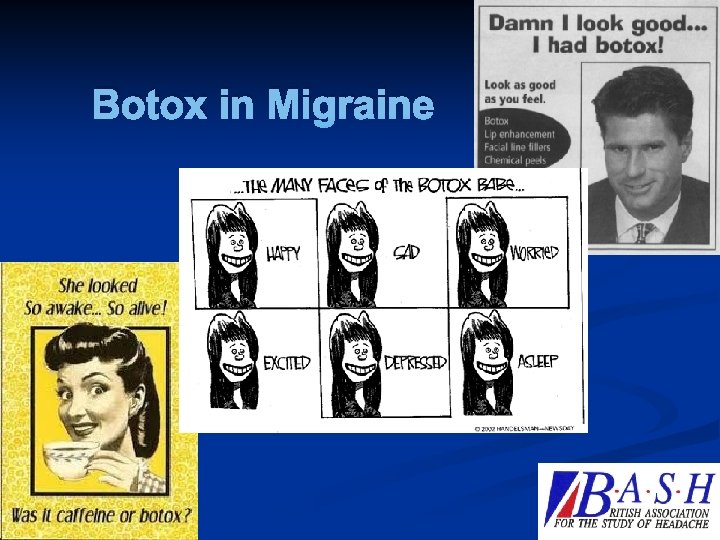 Botox in Migraine 