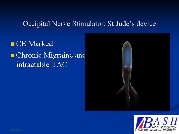 Occipital Nerve Stimulator: St Jude’s device n CE Marked n Chronic Migraine and intractable