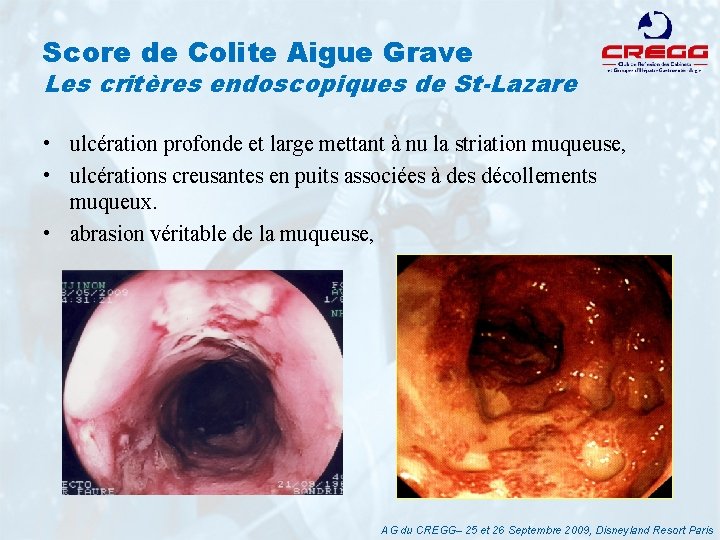 Score de Colite Aigue Grave Les critères endoscopiques de St-Lazare • ulcération profonde et