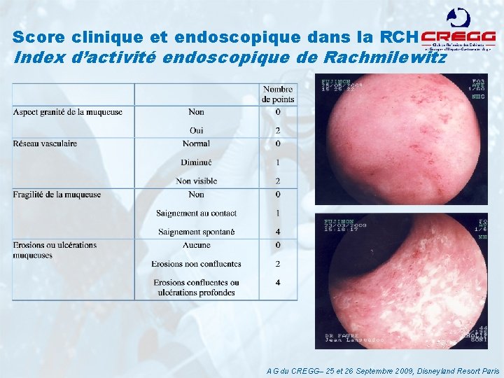 Score clinique et endoscopique dans la RCH Index d’activité endoscopique de Rachmilewitz AG du
