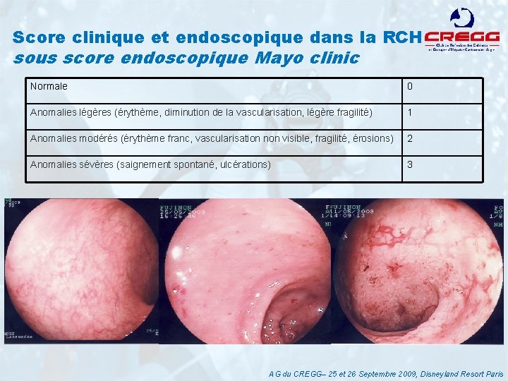 Score clinique et endoscopique dans la RCH sous score endoscopique Mayo clinic Normale 0