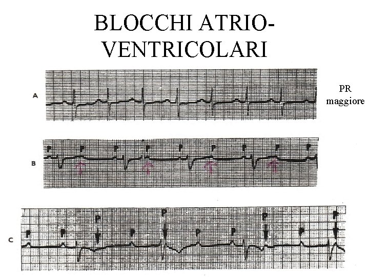 BLOCCHI ATRIOVENTRICOLARI PR maggiore 