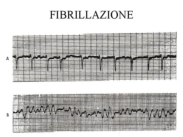 FIBRILLAZIONE 