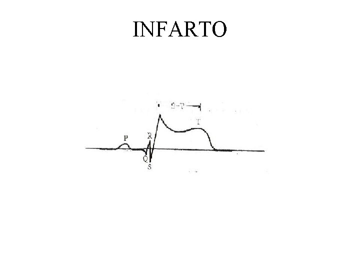 INFARTO 