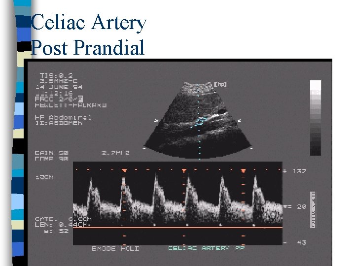 Celiac Artery Post Prandial 