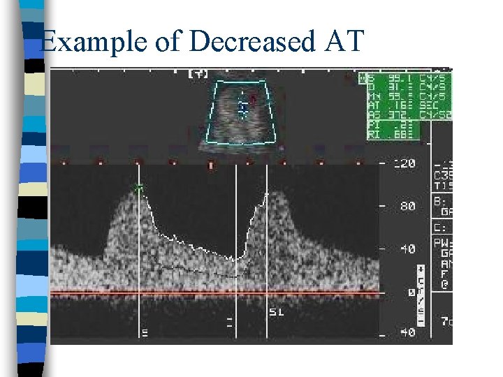 Example of Decreased AT 