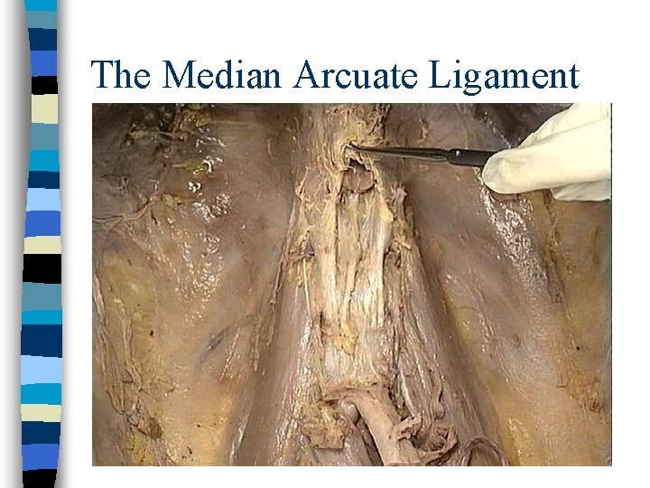 The Median Arcuate Ligament 