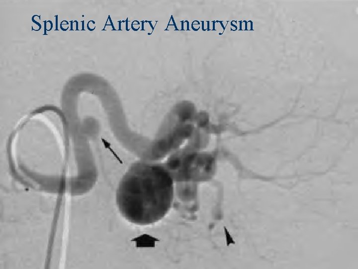 Splenic Artery Aneurysm 