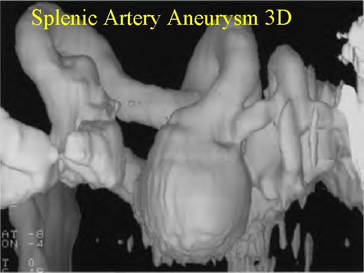 Splenic Artery Aneurysm 3 D 