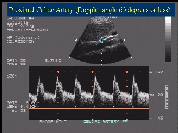 Proximal Celiac Artery (Doppler angle 60 degrees or less) 