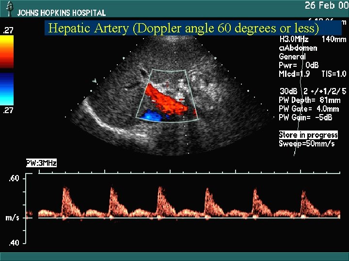 Hepatic Artery (Doppler angle 60 degrees or less) 