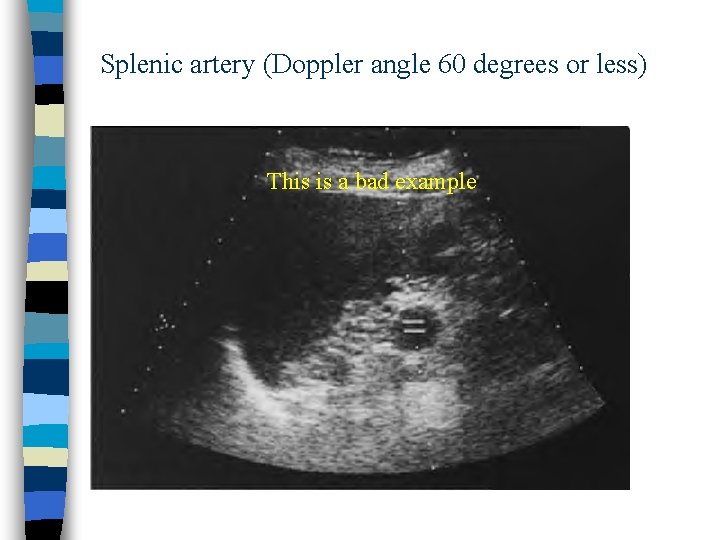 Splenic artery (Doppler angle 60 degrees or less) This is a bad example 