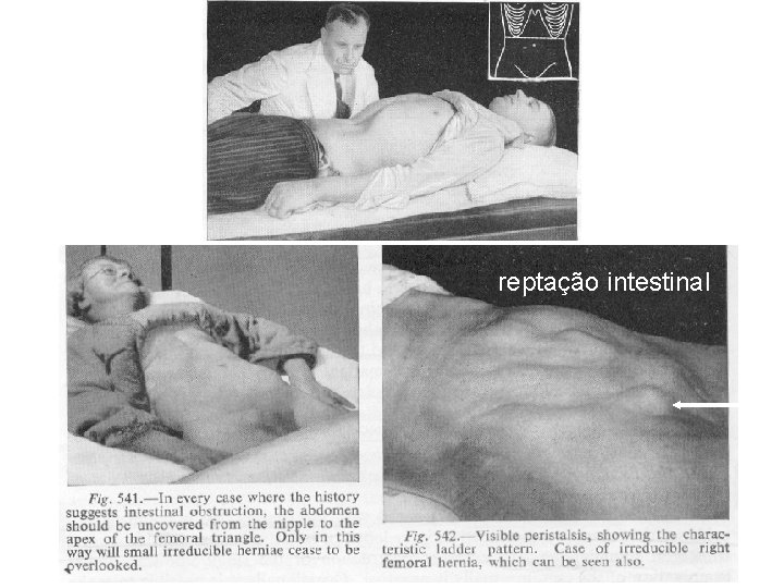 reptação intestinal 