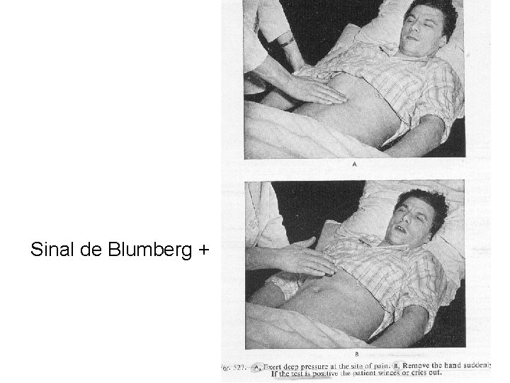 Sinal de Blumberg + 