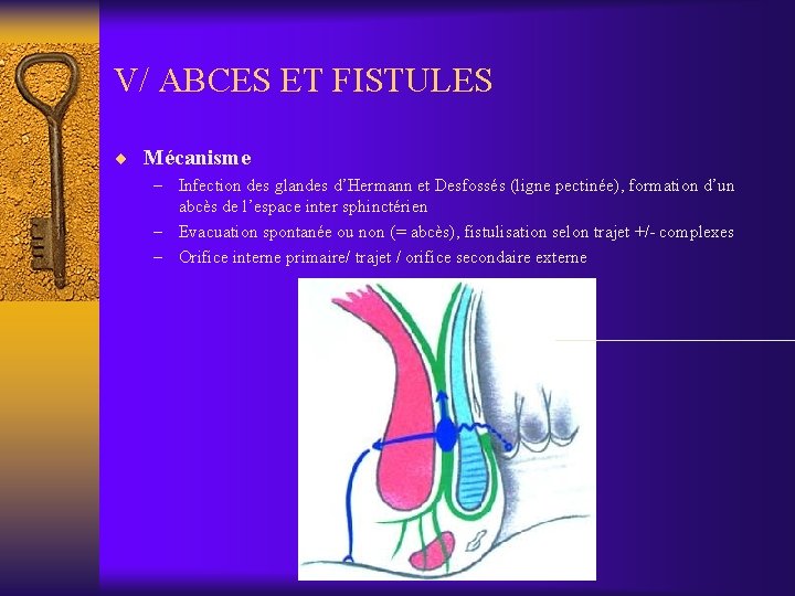 V/ ABCES ET FISTULES ¨ Mécanisme – Infection des glandes d’Hermann et Desfossés (ligne