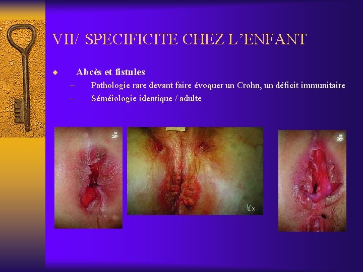 VII/ SPECIFICITE CHEZ L’ENFANT ¨ Abcès et fistules – – Pathologie rare devant faire