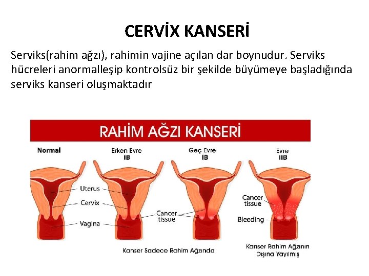 CERVİX KANSERİ Serviks(rahim ağzı), rahimin vajine açılan dar boynudur. Serviks hücreleri anormalleşip kontrolsüz bir