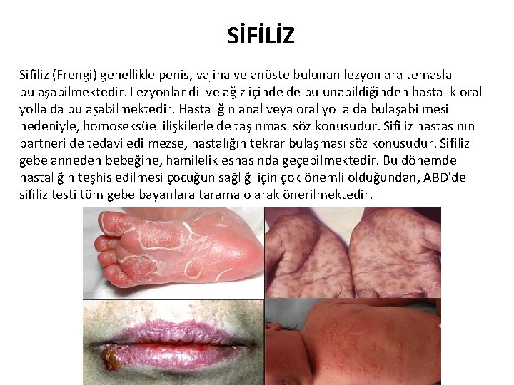 SİFİLİZ Sifiliz (Frengi) genellikle penis, vajina ve anüste bulunan lezyonlara temasla bulaşabilmektedir. Lezyonlar dil