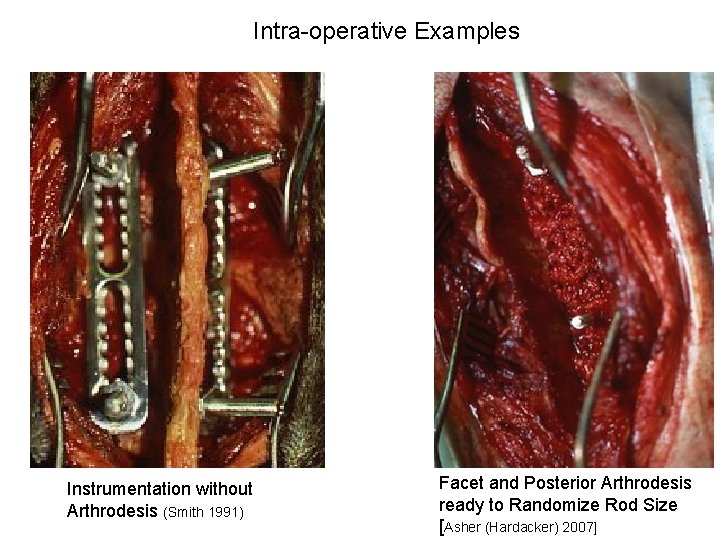 Intra-operative Examples Instrumentation without Arthrodesis (Smith 1991) Facet and Posterior Arthrodesis ready to Randomize