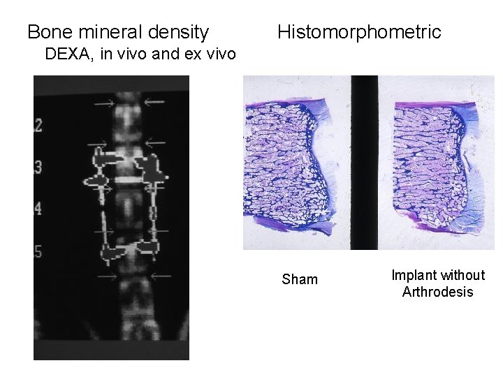 Bone mineral density Histomorphometric DEXA, in vivo and ex vivo Sham Implant without Arthrodesis