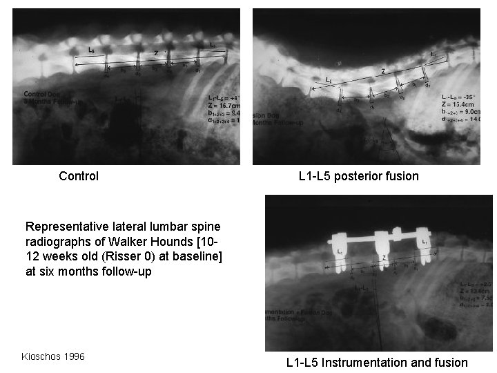 Control L 1 -L 5 posterior fusion Representative lateral lumbar spine radiographs of Walker