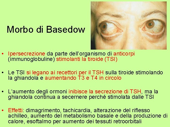 Morbo di Basedow • Ipersecrezione da parte dell’organismo di anticorpi (immunoglobuline) stimolanti la tiroide