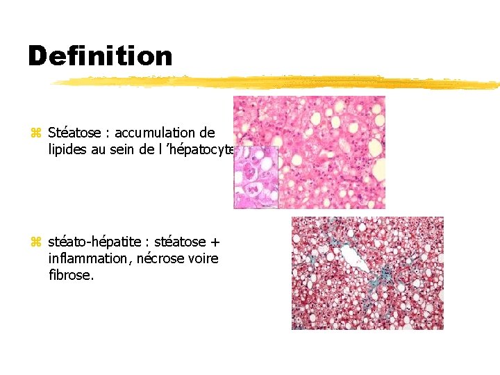 Definition z Stéatose : accumulation de lipides au sein de l ’hépatocyte z stéato-hépatite