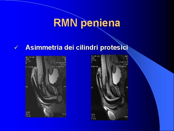 RMN peniena ü Asimmetria dei cilindri protesici 