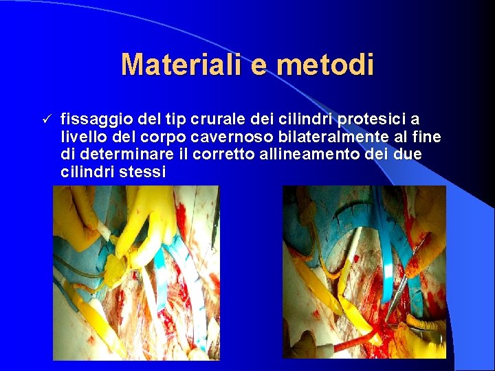 Materiali e metodi ü fissaggio del tip crurale dei cilindri protesici a livello del