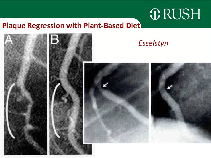 Plaque Regression with Plant-Based Diet Esselstyn 