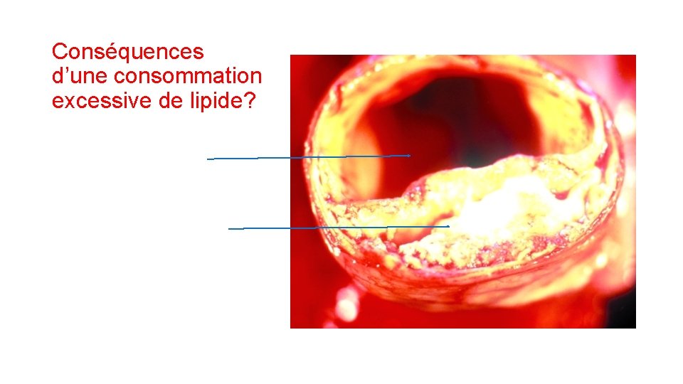 Conséquences d’une consommation excessive de lipide? Conséquences d’une consommation excessive de lipide?