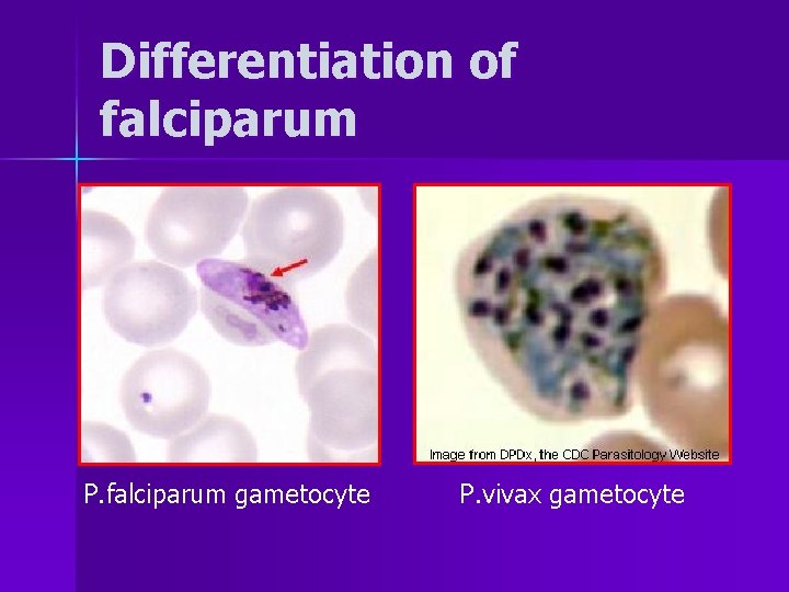 Differentiation of falciparum P. falciparum gametocyte P. vivax gametocyte 