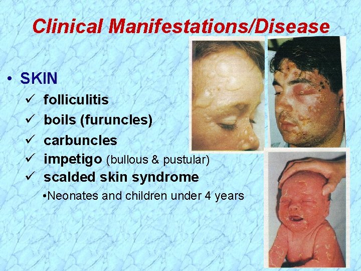 Clinical Manifestations/Disease • SKIN folliculitis boils (furuncles) carbuncles impetigo (bullous & pustular) scalded skin