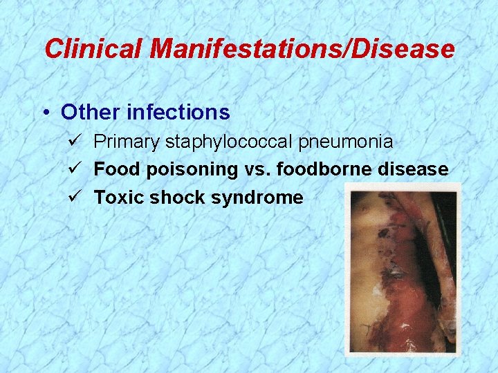 Clinical Manifestations/Disease • Other infections Primary staphylococcal pneumonia Food poisoning vs. foodborne disease Toxic