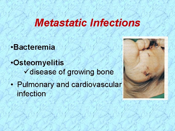 Metastatic Infections • Bacteremia • Osteomyelitis disease of growing bone • Pulmonary and cardiovascular